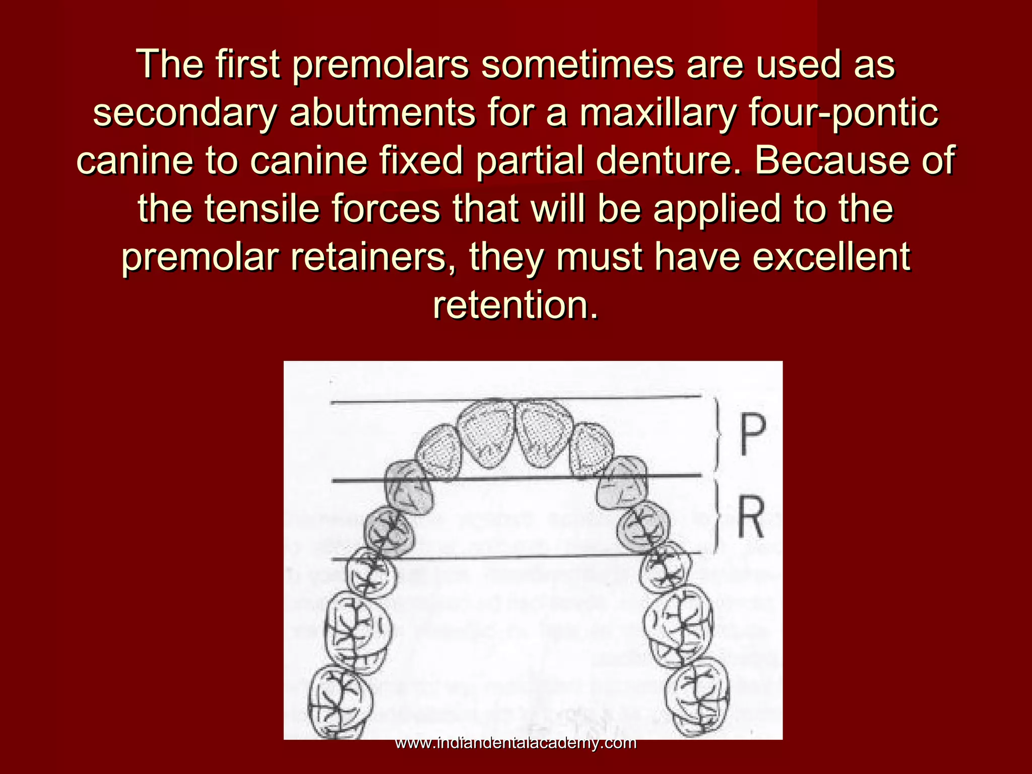 The first premolars sometimes are used as
secondary abutments for a maxillary four-pontic
canine to canine fixed partial denture. Because of
the tensile forces that will be applied to the
premolar retainers, they must have excellent
retention.

www.indiandentalacademy.com

 