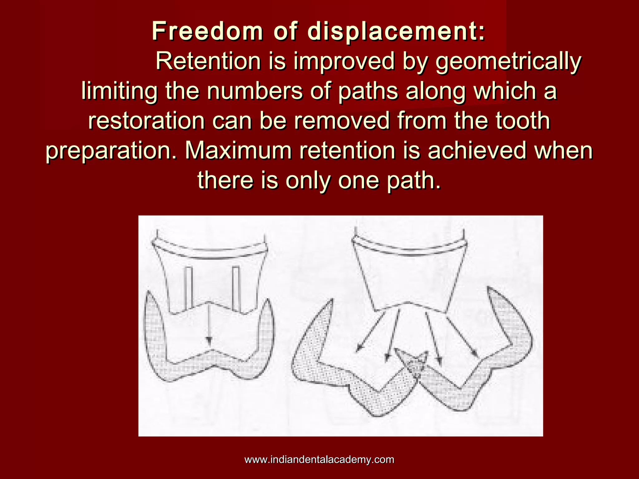 Freedom of displacement:
Retention is improved by geometrically
limiting the numbers of paths along which a
restoration can be removed from the tooth
preparation. Maximum retention is achieved when
there is only one path.

www.indiandentalacademy.com

 