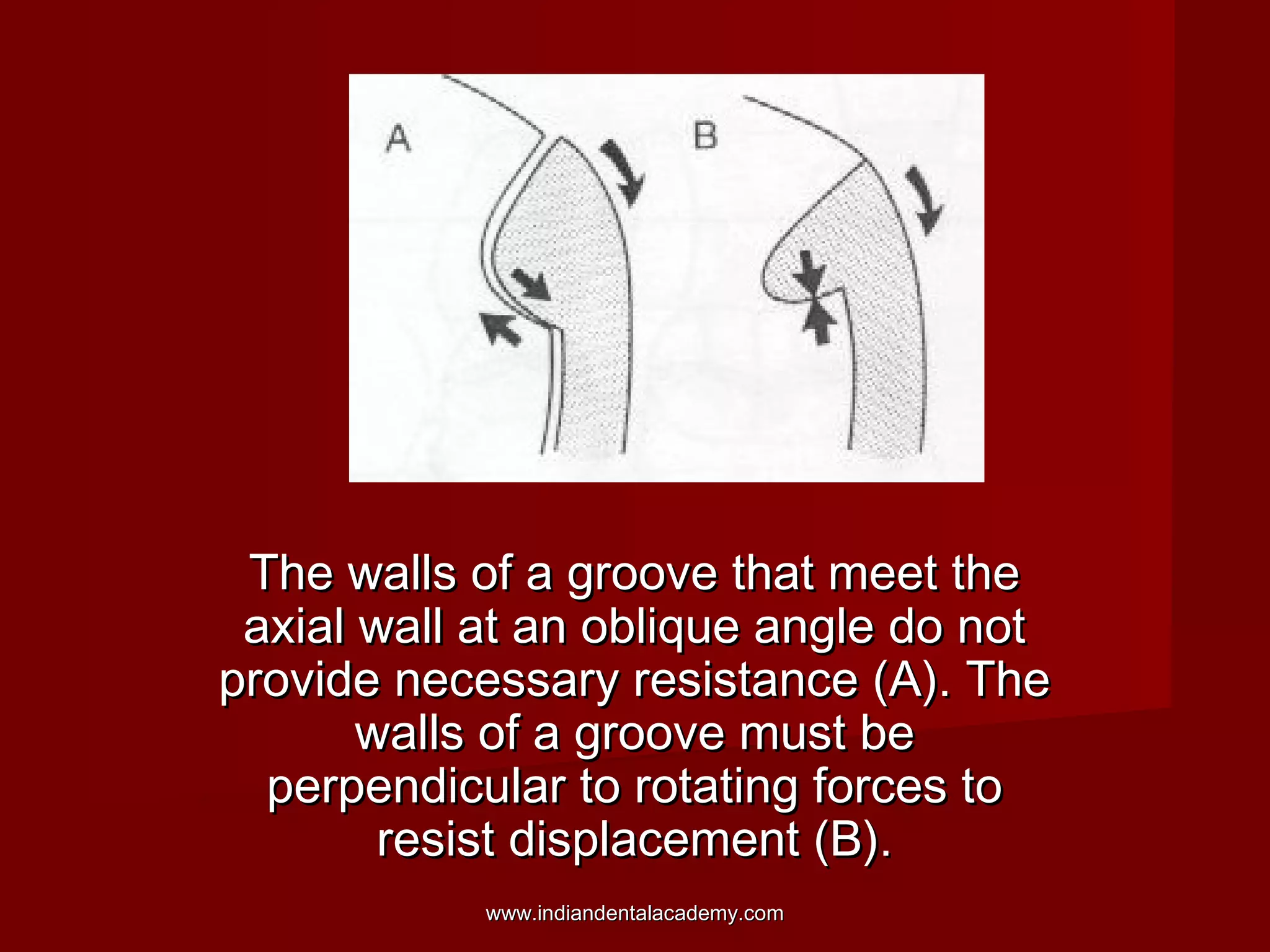 The walls of a groove that meet the
axial wall at an oblique angle do not
provide necessary resistance (A). The
walls of a groove must be
perpendicular to rotating forces to
resist displacement (B).
www.indiandentalacademy.com

 