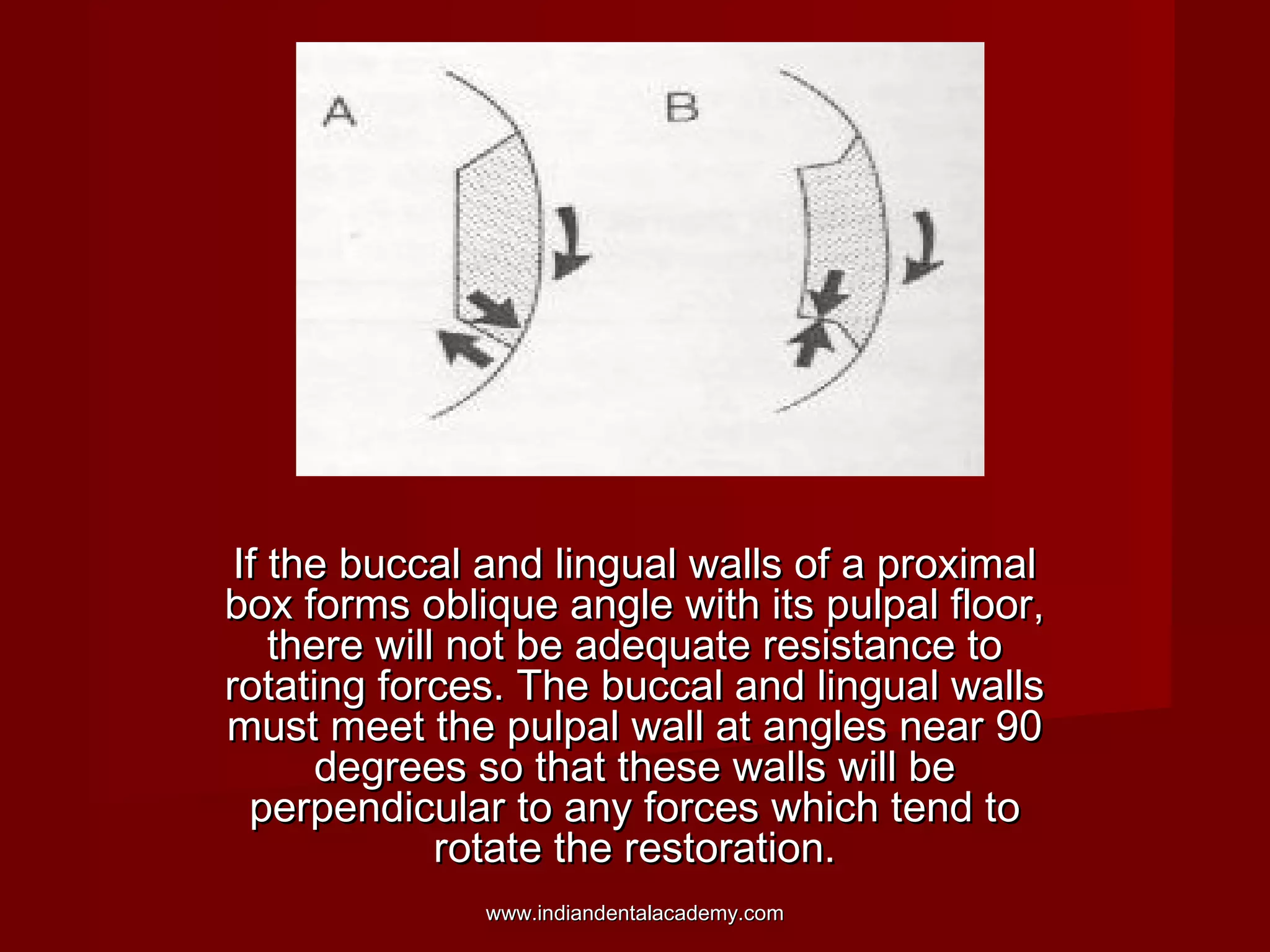 If the buccal and lingual walls of a proximal
box forms oblique angle with its pulpal floor,
there will not be adequate resistance to
rotating forces. The buccal and lingual walls
must meet the pulpal wall at angles near 90
degrees so that these walls will be
perpendicular to any forces which tend to
rotate the restoration.
www.indiandentalacademy.com

 