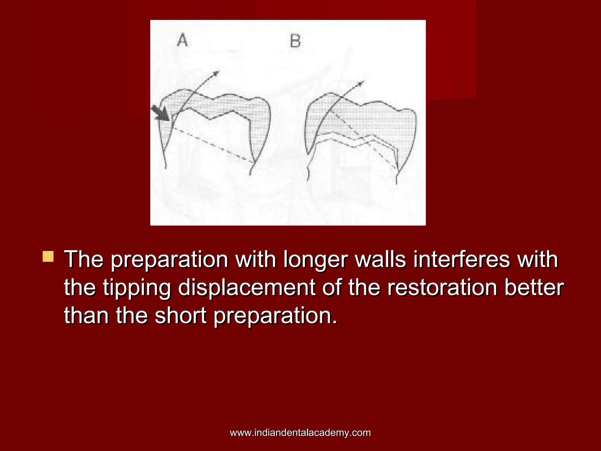 

The preparation with longer walls interferes with
the tipping displacement of the restoration better
than the short preparation.

www.indiandentalacademy.com

 