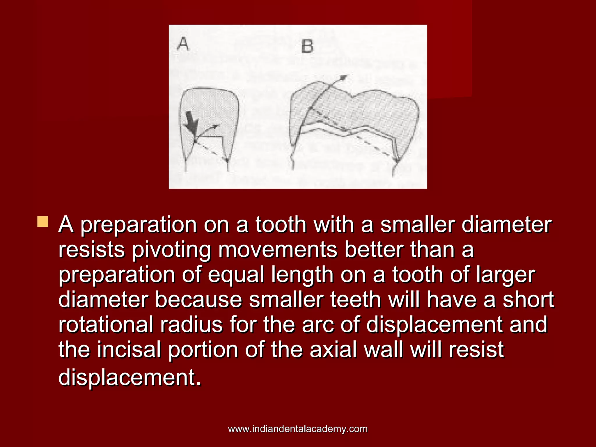 

A preparation on a tooth with a smaller diameter
resists pivoting movements better than a
preparation of equal length on a tooth of larger
diameter because smaller teeth will have a short
rotational radius for the arc of displacement and
the incisal portion of the axial wall will resist
displacement.
www.indiandentalacademy.com

 
