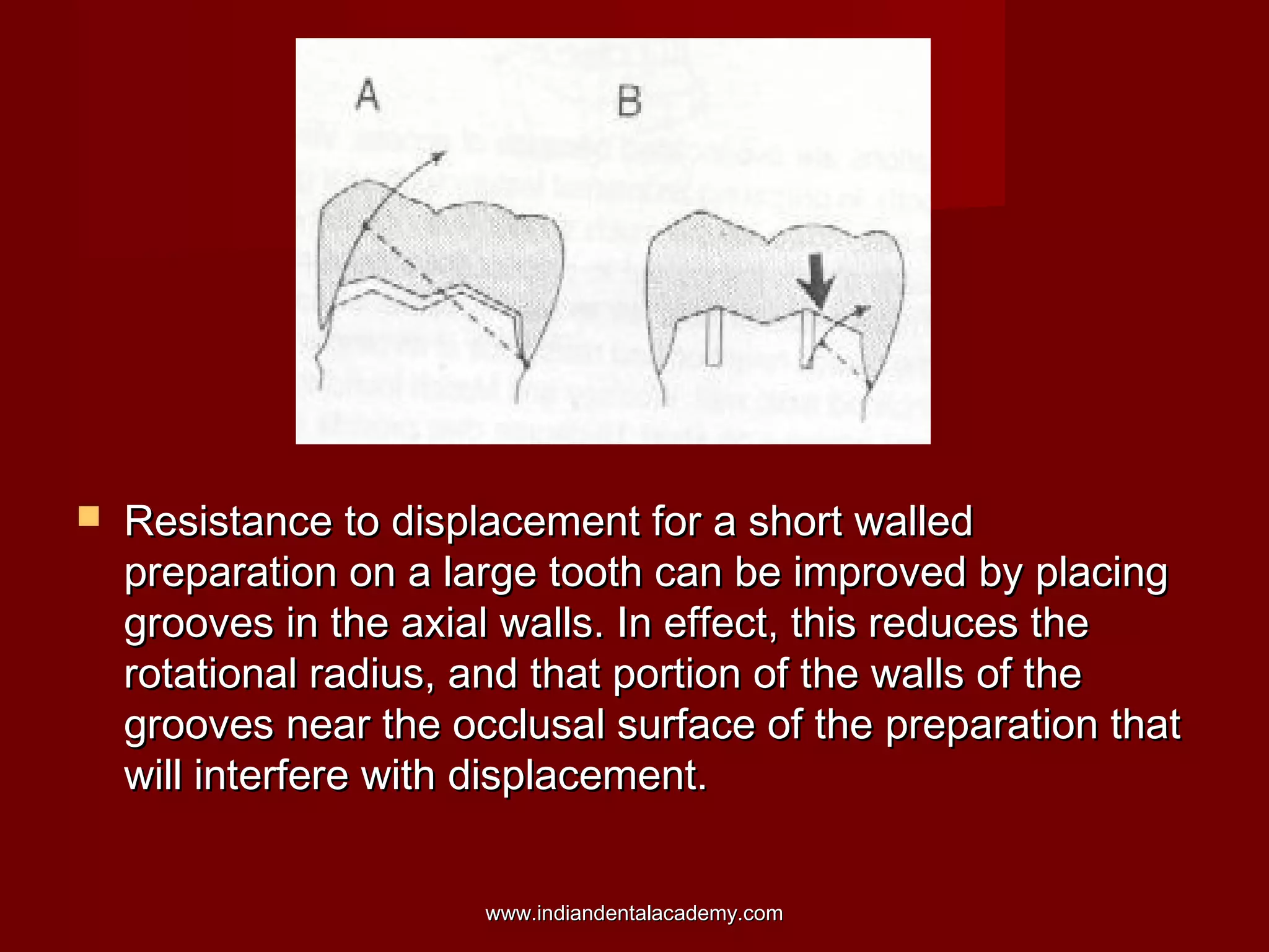 

Resistance to displacement for a short walled
preparation on a large tooth can be improved by placing
grooves in the axial walls. In effect, this reduces the
rotational radius, and that portion of the walls of the
grooves near the occlusal surface of the preparation that
will interfere with displacement.
www.indiandentalacademy.com

 