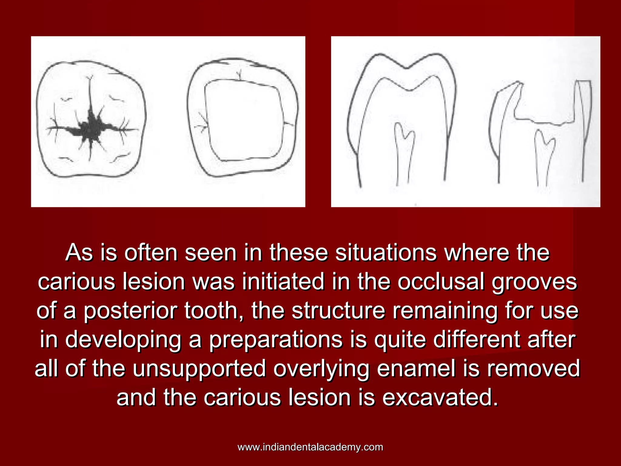 As is often seen in these situations where the
carious lesion was initiated in the occlusal grooves
of a posterior tooth, the structure remaining for use
in developing a preparations is quite different after
all of the unsupported overlying enamel is removed
and the carious lesion is excavated.
www.indiandentalacademy.com

 
