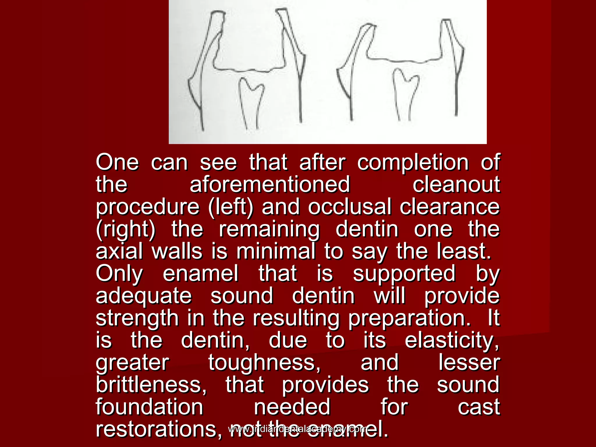 One can see that after completion of
the
aforementioned
cleanout
procedure (left) and occlusal clearance
(right) the remaining dentin one the
axial walls is minimal to say the least.
Only enamel that is supported by
adequate sound dentin will provide
strength in the resulting preparation. It
is the dentin, due to its elasticity,
greater
toughness,
and
lesser
brittleness, that provides the sound
foundation
needed
for
cast
restorations, www.indiandentalacademy.com
not the enamel.

 