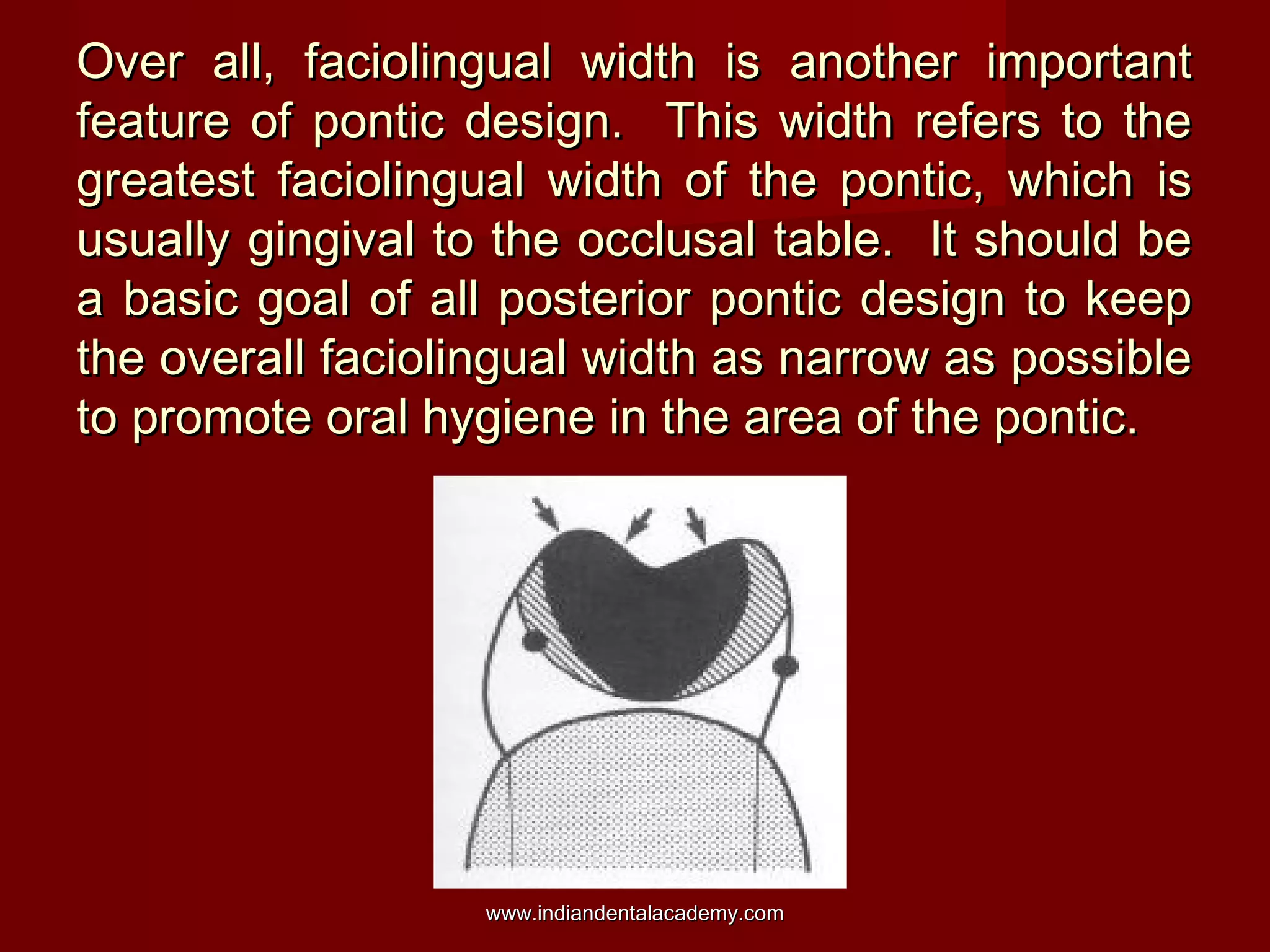 Over all, faciolingual width is another important
feature of pontic design. This width refers to the
greatest faciolingual width of the pontic, which is
usually gingival to the occlusal table. It should be
a basic goal of all posterior pontic design to keep
the overall faciolingual width as narrow as possible
to promote oral hygiene in the area of the pontic.

www.indiandentalacademy.com

 