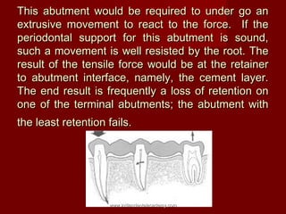 This abutment would be required to under go an
extrusive movement to react to the force. If the
periodontal support for th...