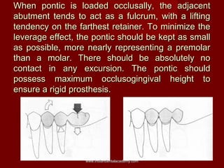 When pontic is loaded occlusally, the adjacent
abutment tends to act as a fulcrum, with a lifting
tendency on the farthest...