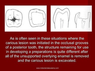 As is often seen in these situations where the
carious lesion was initiated in the occlusal grooves
of a posterior tooth, ...