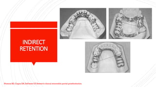 Indirect Retention In Rpd biomechanics in dentistry and applications | PPTX