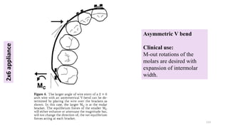 Asymmetric V bend
Clinical use:
M-out rotations of the
molars are desired with
expansion of intermolar
width.
113
2x6
appliance
 