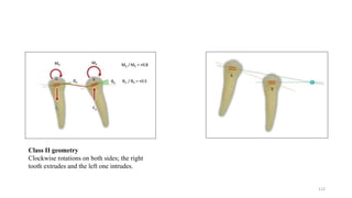 Class II geometry
Clockwise rotations on both sides; the right
tooth extrudes and the left one intrudes.
122
 