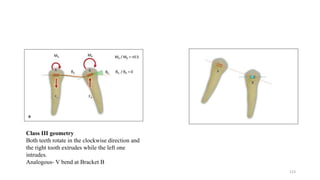 Class III geometry
Both teeth rotate in the clockwise direction and
the right tooth extrudes while the left one
intrudes.
Analogous- V bend at Bracket B
123
 
