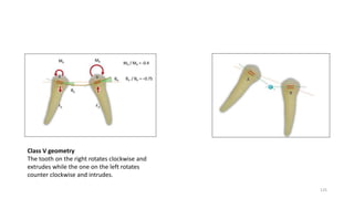 Class V geometry
The tooth on the right rotates clockwise and
extrudes while the one on the left rotates
counter clockwise and intrudes.
125
 
