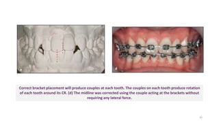 Correct bracket placement will produce couples at each tooth. The couples on each tooth produce rotation
of each tooth around its CR. (d) The midline was corrected using the couple acting at the brackets without
requiring any lateral force.
43
 