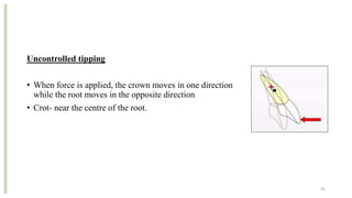 Uncontrolled tipping
• When force is applied, the crown moves in one direction
while the root moves in the opposite direction
• Crot- near the centre of the root.
45
 