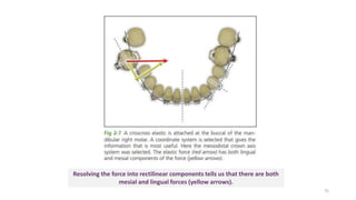 Resolving the force into rectilinear components tells us that there are both
mesial and lingual forces (yellow arrows).
75
 