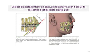 Clinical examples of how an equivalence analysis can help us to
select the best possible elastic pull.
88
 