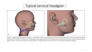 Typical cervical headgear
89
 