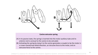 Canine extrusion spring.
(A) In its passive state, the spring is inserted into the molar auxiliary tube and its
anterior end is occlusal to the canine to be extruded.
(B) Activating the spring by tying it to the canine generates a couple to tip the molar in
a crown-mesial/root-distal direction, an intrusive force to the molar, and an
extrusive force to the canine.
Lindauer S J, Isaacson R J. One-Couple Orthodontic Appliance Systems. Seminars in Orthodontics. 1995;1(1):12-24.
98
 