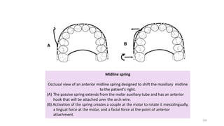 Midline spring
Occlusal view of an anterior midline spring designed to shift the maxillary midline
to the patient's right.
(A) The passive spring extends from the molar auxiliary tube and has an anterior
hook that will be attached over the arch wire.
(B) Activation of the spring creates a couple at the molar to rotate it mesiolingually,
a lingual force at the molar, and a facial force at the point of anterior
attachment.
100
 