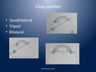 biomechanics of removable partial denture | PPTX