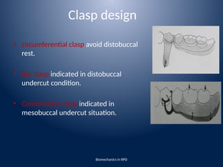 biomechanics of removable partial denture | PPTX