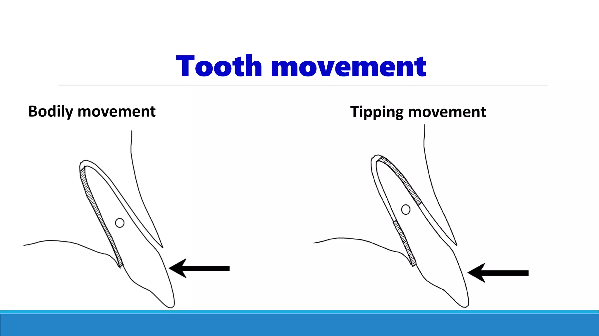 Tooth movement
Tipping movementBodily movement
 