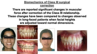 Biomechanics and treatment of skeletal deformities part 2 | PPTX