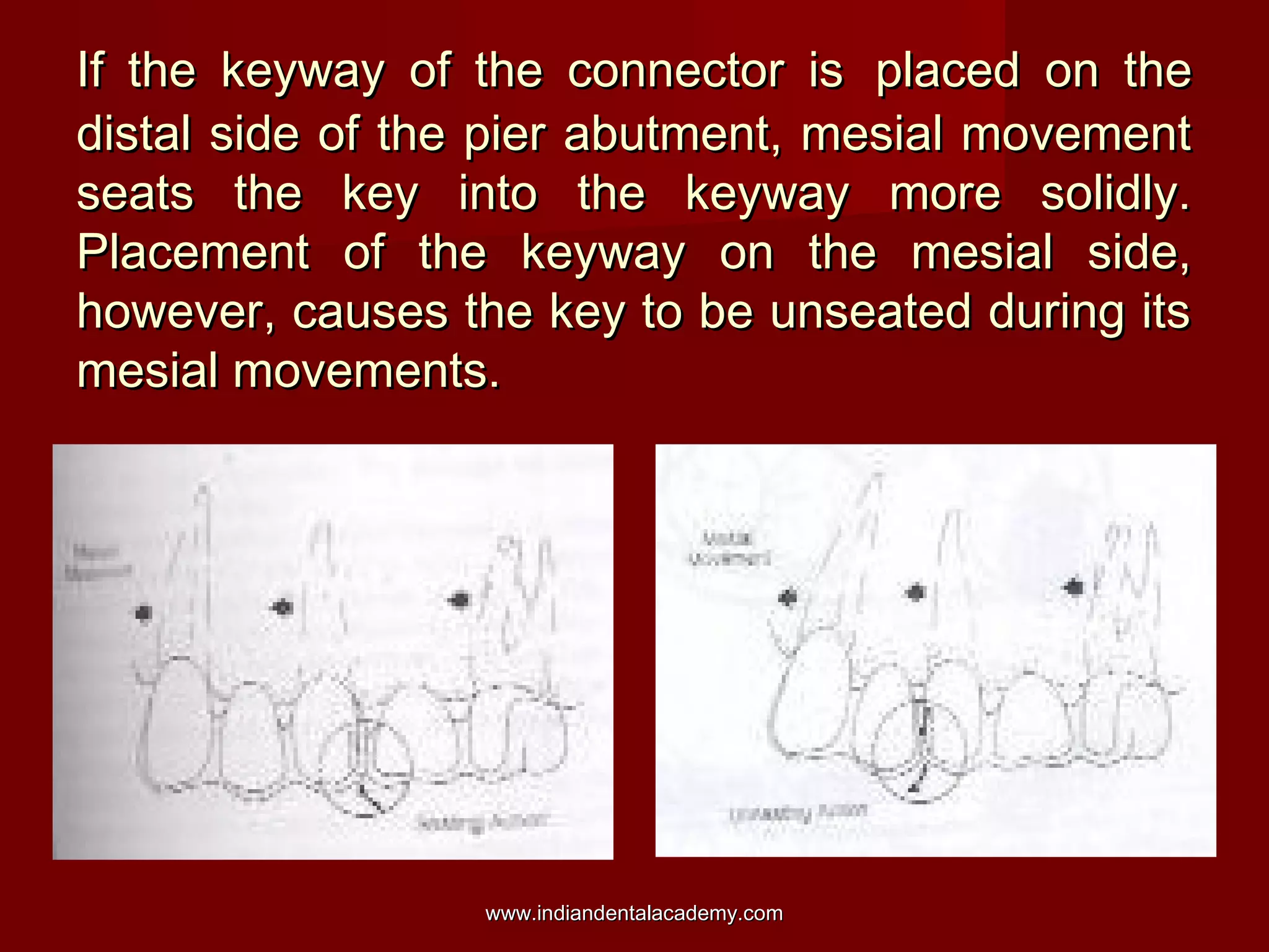 If the keyway of the connector isIf the keyway of the connector is placed on theplaced on the
distal side of the pier abutment, mesial movementdistal side of the pier abutment, mesial movement
seats the key into the keyway more solidly.seats the key into the keyway more solidly.
Placement of the keyway on the mesial side,Placement of the keyway on the mesial side,
however, causes the key to be unseated during itshowever, causes the key to be unseated during its
mesial movements.mesial movements.
www.indiandentalacademy.comwww.indiandentalacademy.com
 
