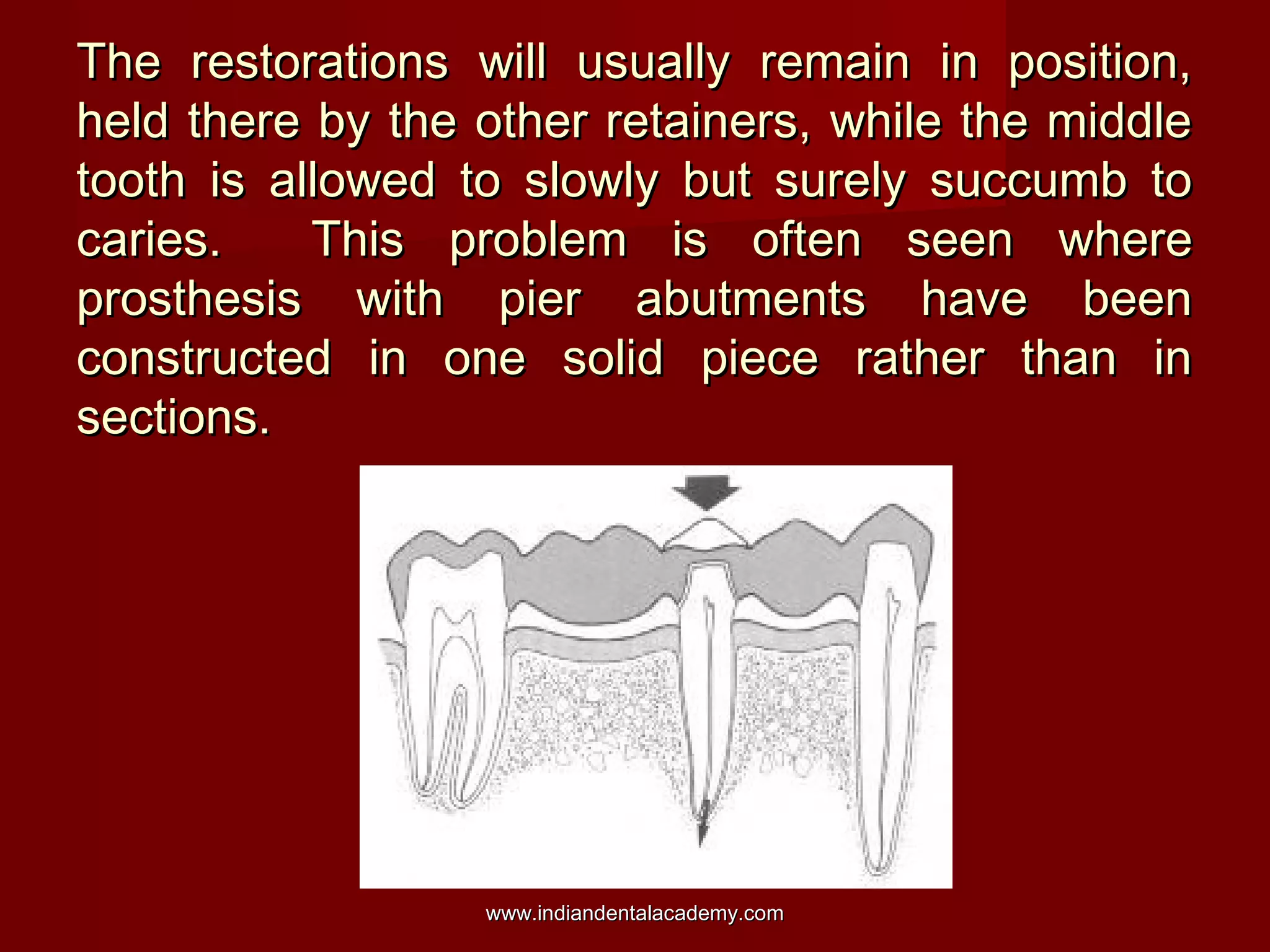 The restorations will usually remain in position,The restorations will usually remain in position,
held there by the other retainers, while the middleheld there by the other retainers, while the middle
tooth is allowed to slowly but surely succumb totooth is allowed to slowly but surely succumb to
caries. This problem is often seen wherecaries. This problem is often seen where
prosthesis with pier abutments have beenprosthesis with pier abutments have been
constructed in one solid piece rather than inconstructed in one solid piece rather than in
sections.sections.
www.indiandentalacademy.comwww.indiandentalacademy.com
 