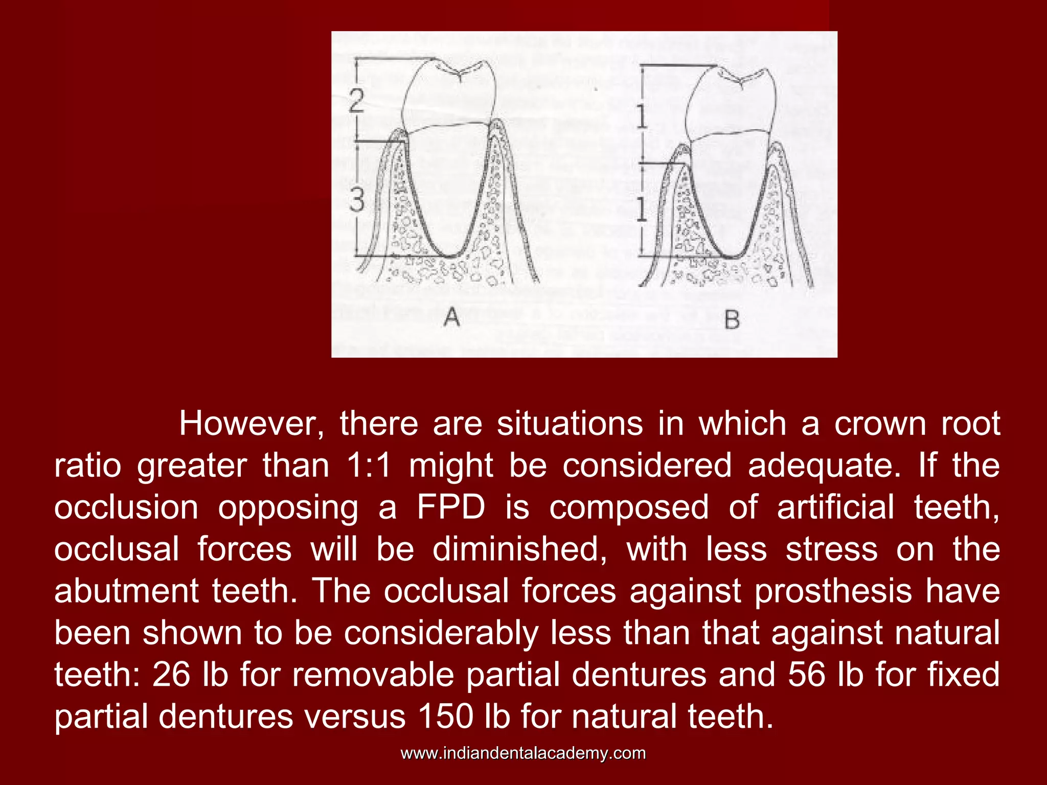 However, there are situations in which a crown root
ratio greater than 1:1 might be considered adequate. If the
occlusion opposing a FPD is composed of artificial teeth,
occlusal forces will be diminished, with less stress on the
abutment teeth. The occlusal forces against prosthesis have
been shown to be considerably less than that against natural
teeth: 26 lb for removable partial dentures and 56 lb for fixed
partial dentures versus 150 lb for natural teeth.
www.indiandentalacademy.comwww.indiandentalacademy.com
 