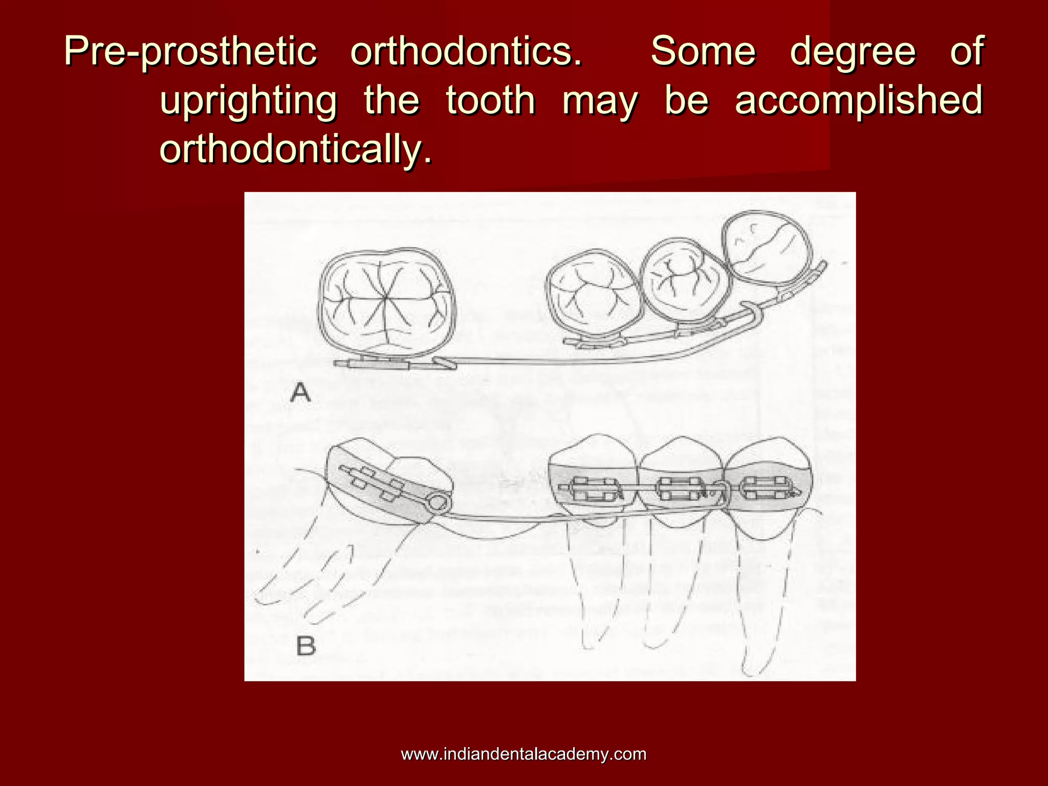 Pre-prosthetic orthodontics. Some degree ofPre-prosthetic orthodontics. Some degree of
uprighting the tooth may be accomplisheduprighting the tooth may be accomplished
orthodontically.orthodontically.
www.indiandentalacademy.comwww.indiandentalacademy.com
 