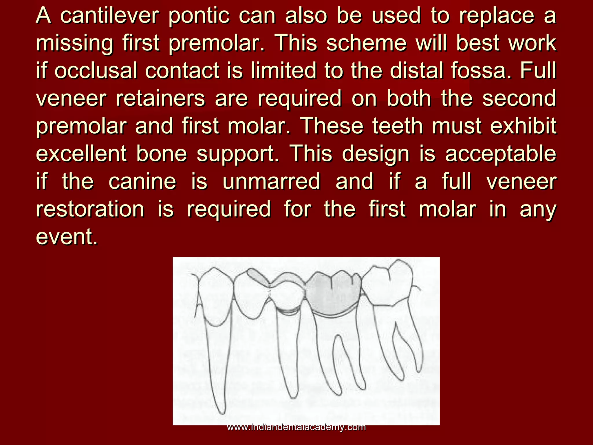 A cantilever pontic can also be used to replace aA cantilever pontic can also be used to replace a
missing first premolar. This scheme will best workmissing first premolar. This scheme will best work
if occlusal contact is limited to the distal fossa. Fullif occlusal contact is limited to the distal fossa. Full
veneer retainers are required on both the secondveneer retainers are required on both the second
premolar and first molar. These teeth must exhibitpremolar and first molar. These teeth must exhibit
excellent bone support. This design is acceptableexcellent bone support. This design is acceptable
if the canine is unmarred and if a full veneerif the canine is unmarred and if a full veneer
restoration is required for the first molar in anyrestoration is required for the first molar in any
event.event.
www.indiandentalacademy.comwww.indiandentalacademy.com
 