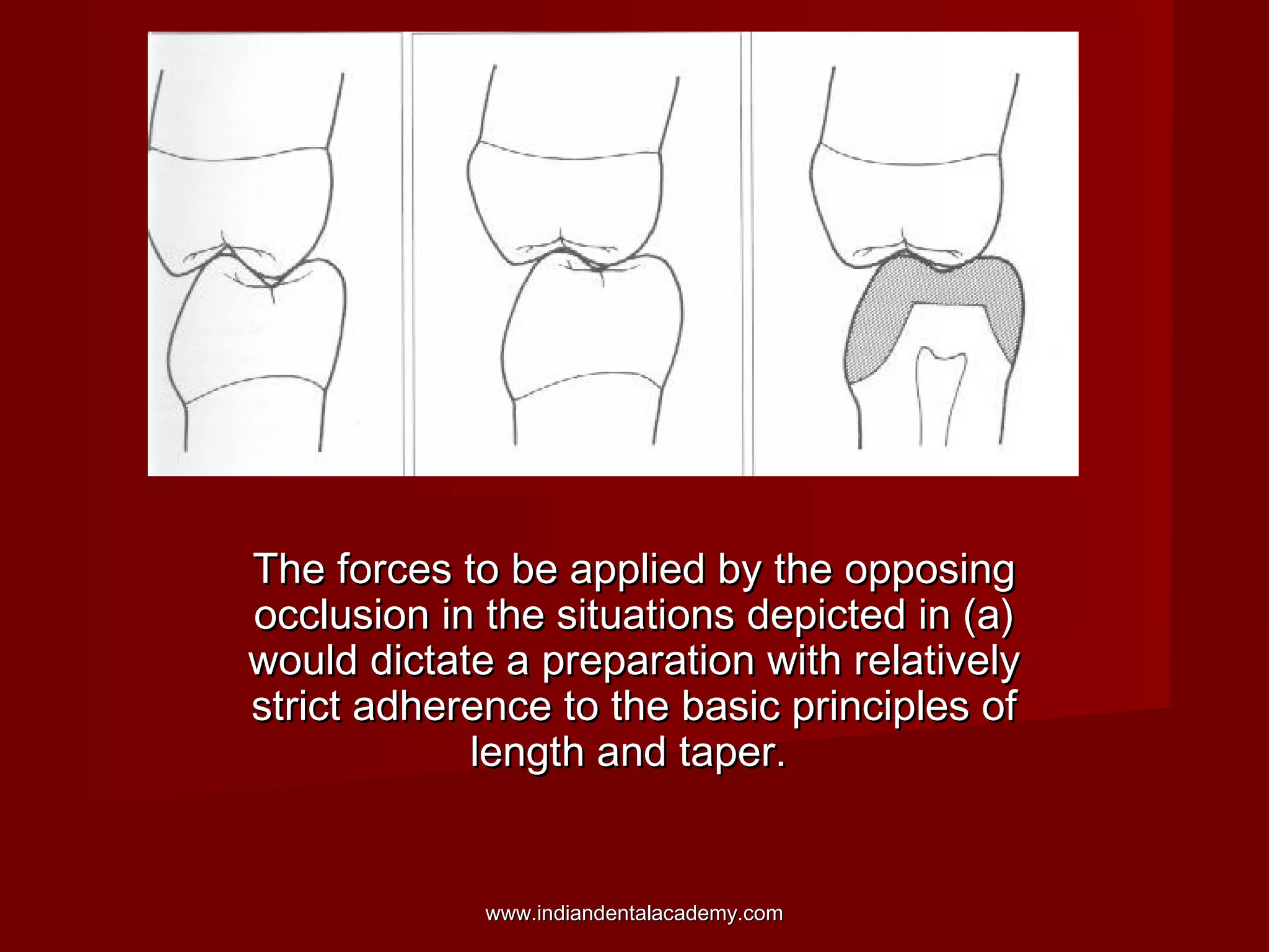 The forces to be applied by the opposingThe forces to be applied by the opposing
occlusion in the situations depicted in (a)occlusion in the situations depicted in (a)
would dictate a preparation with relativelywould dictate a preparation with relatively
strict adherence to the basic principles ofstrict adherence to the basic principles of
length and taper.length and taper.
www.indiandentalacademy.comwww.indiandentalacademy.com
 