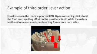 Lever System Rpd Biomechanics in removable partial denture | PPTX