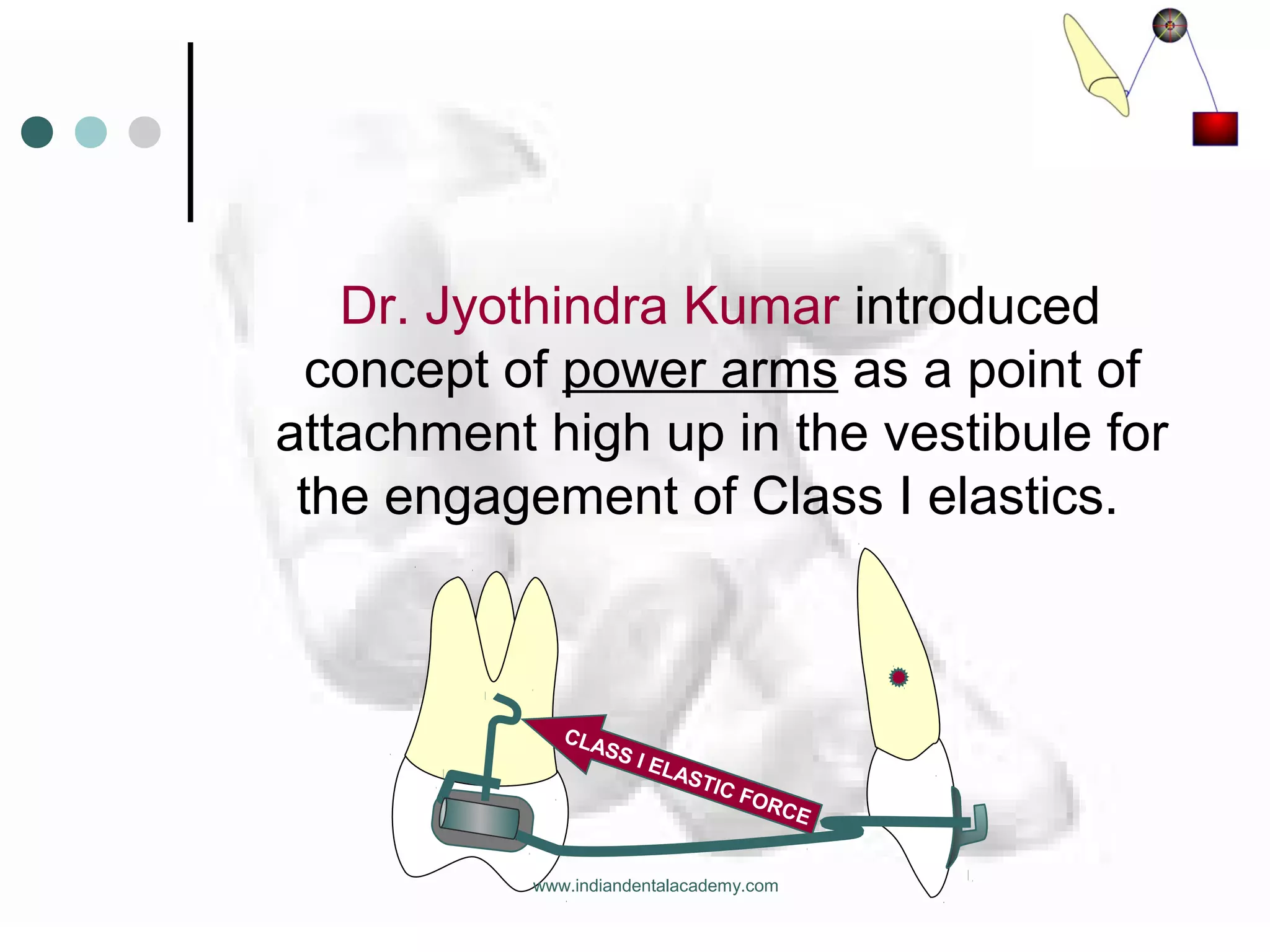 Dr. Jyothindra Kumar introduced
concept of power arms as a point of
attachment high up in the vestibule for
the engagement of Class I elastics.
CLASS I ELASTIC FORCE
www.indiandentalacademy.com
 