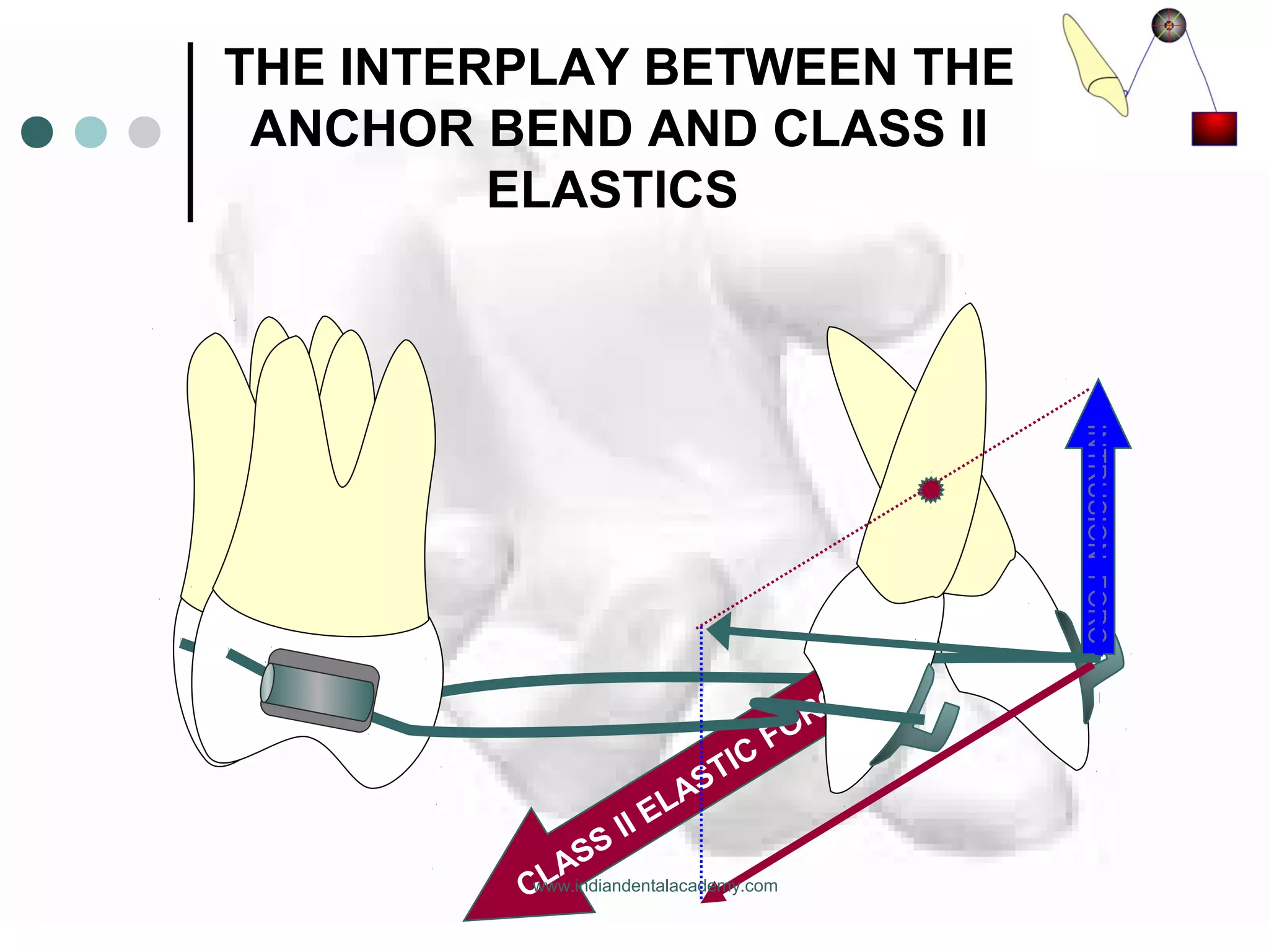 THE INTERPLAY BETWEEN THE
ANCHOR BEND AND CLASS II
ELASTICS
CLASS II ELASTIC
FORCE
INTRUSIONFORC
www.indiandentalacademy.com
 