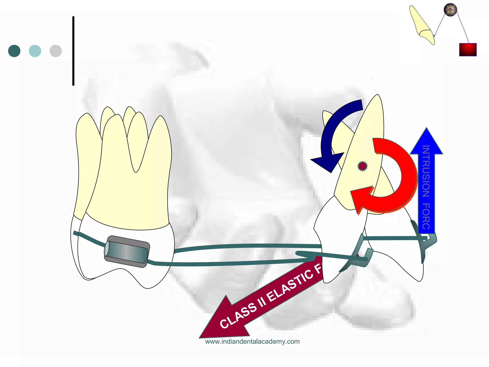 CLASS II ELASTIC
FORCE
INTRUSIONFORC
www.indiandentalacademy.com
 