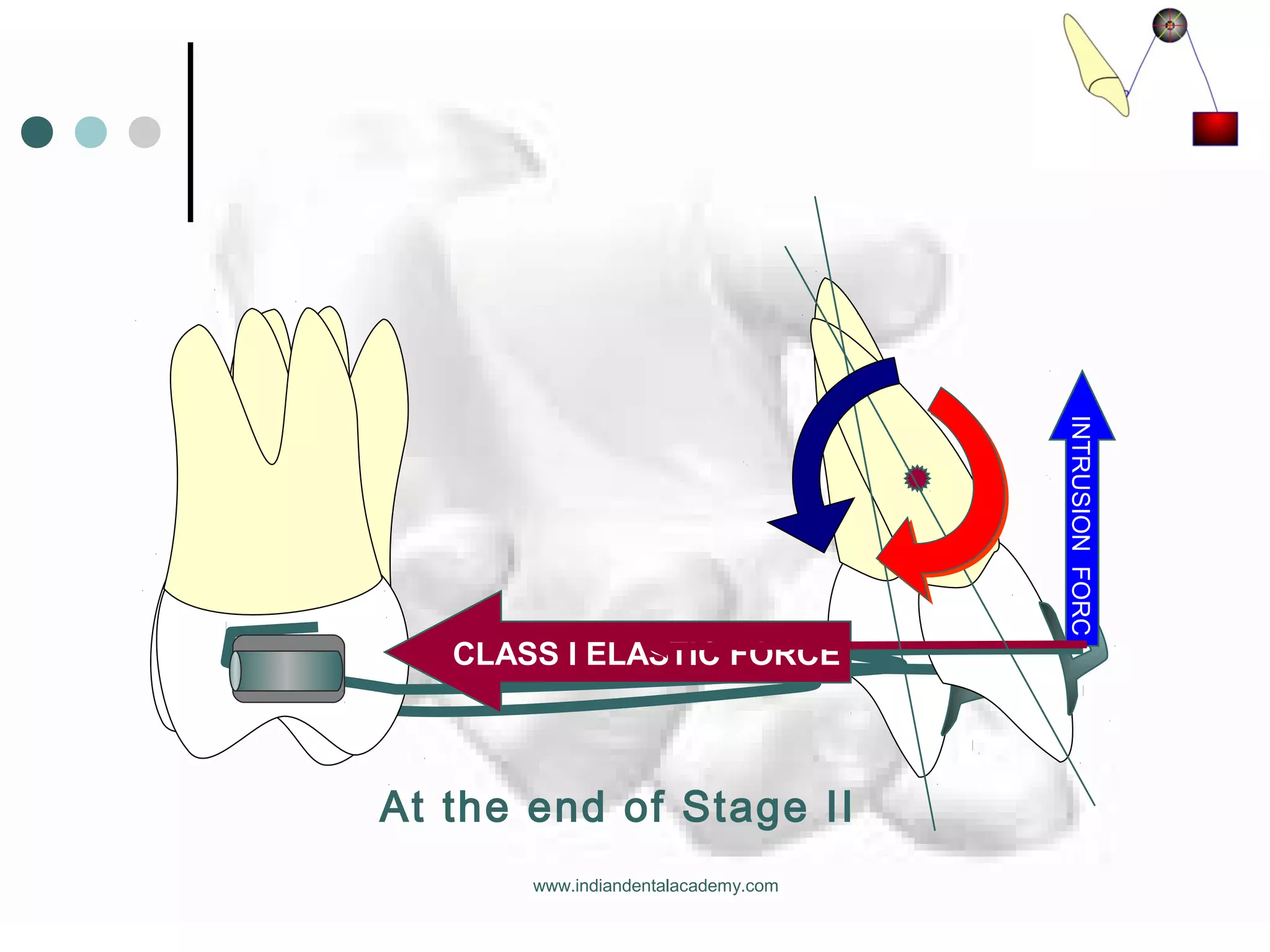 CLASS I ELASTIC FORCE
INTRUSIONFORC
At the end of Stage II
www.indiandentalacademy.com
 