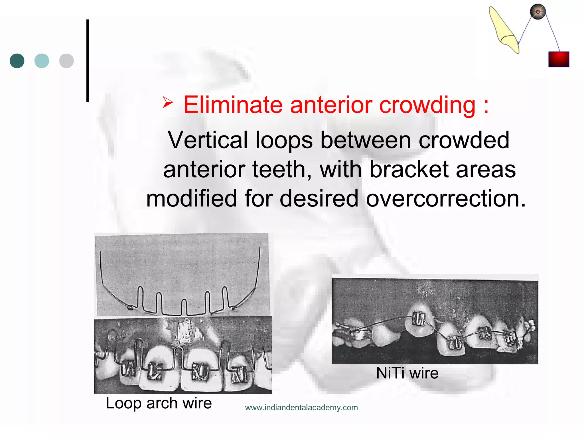  Eliminate anterior crowding :
Vertical loops between crowded
anterior teeth, with bracket areas
modified for desired overcorrection.
Loop arch wire
NiTi wire
www.indiandentalacademy.com
 