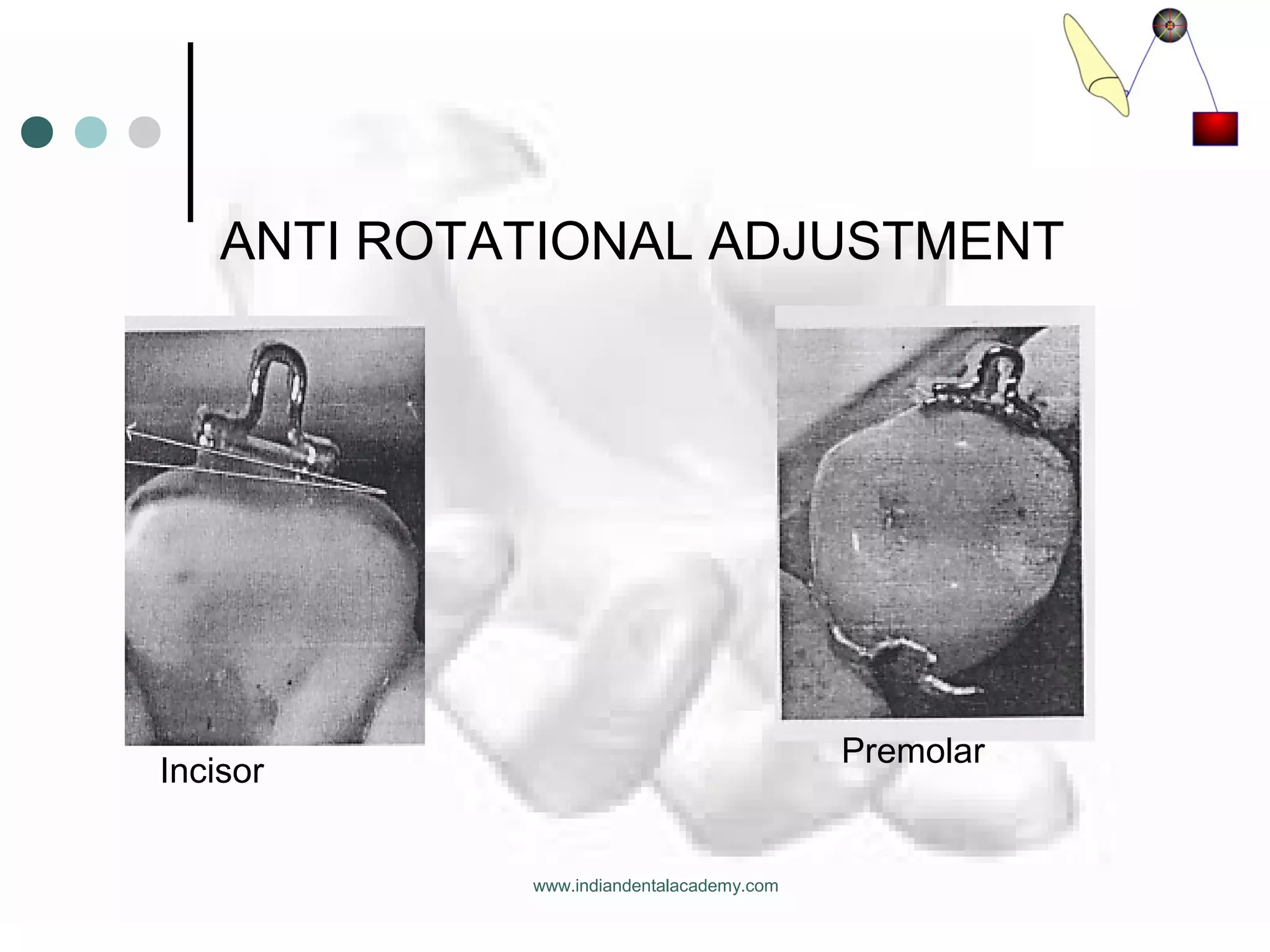 ANTI ROTATIONAL ADJUSTMENT
Incisor
Premolar
www.indiandentalacademy.com
 