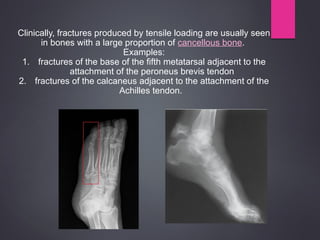 Comprehensive Biomechanics of Bones: Structure, Loading, and Fracture ...