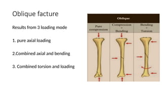 Comprehensive Biomechanics of Fracture: Bone Properties, Forces, and ...