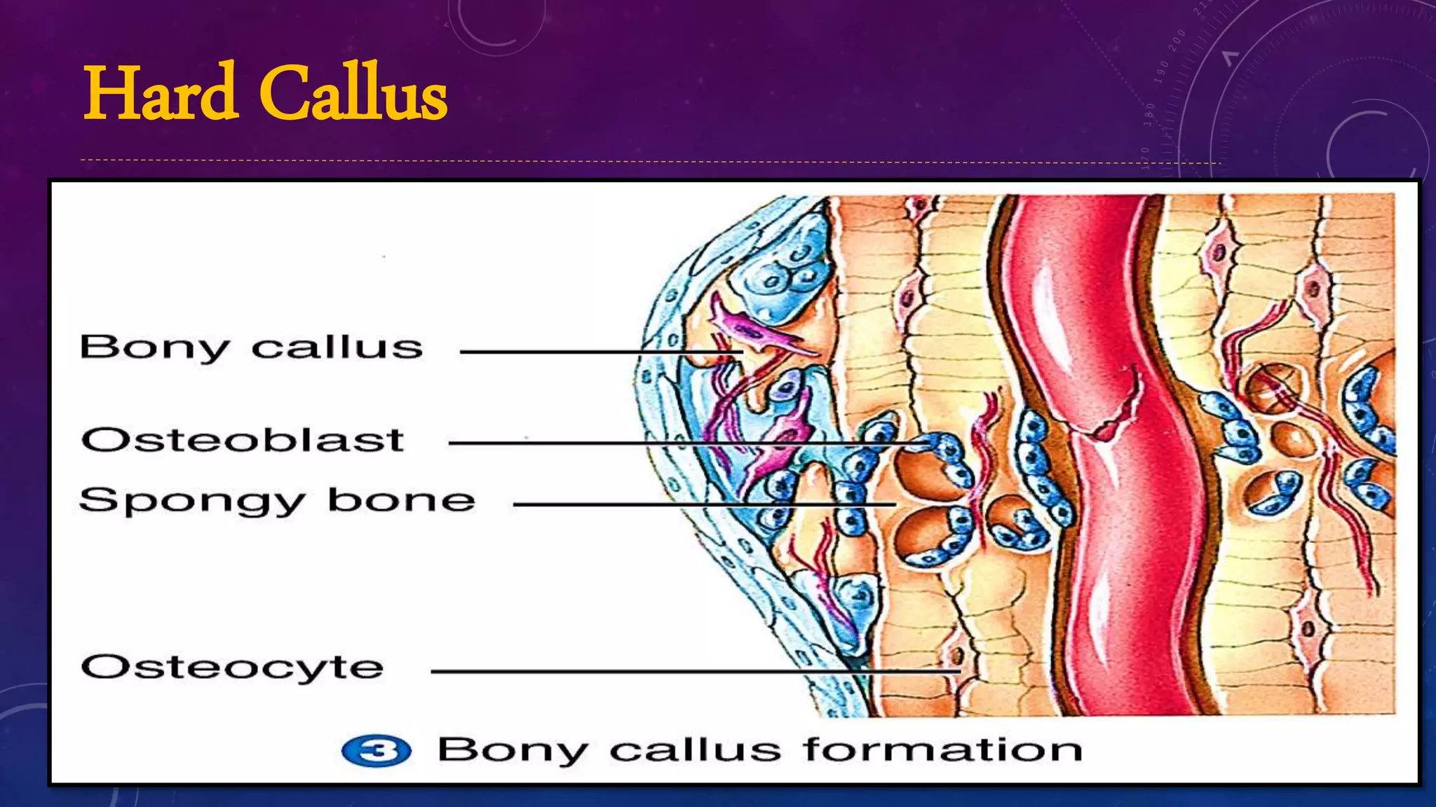 Bone Callouses Biomechanics of fracture and fracture healing | PPTX