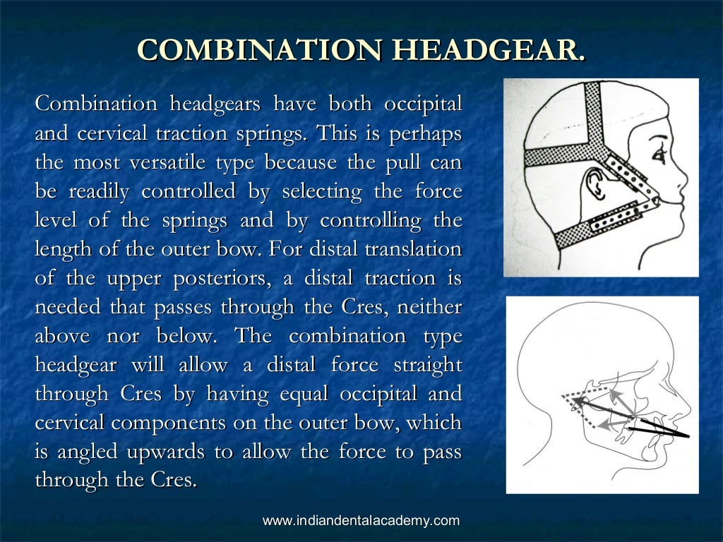 Biomechanics of headgears in orthodontics /certified fixed orthodonti…