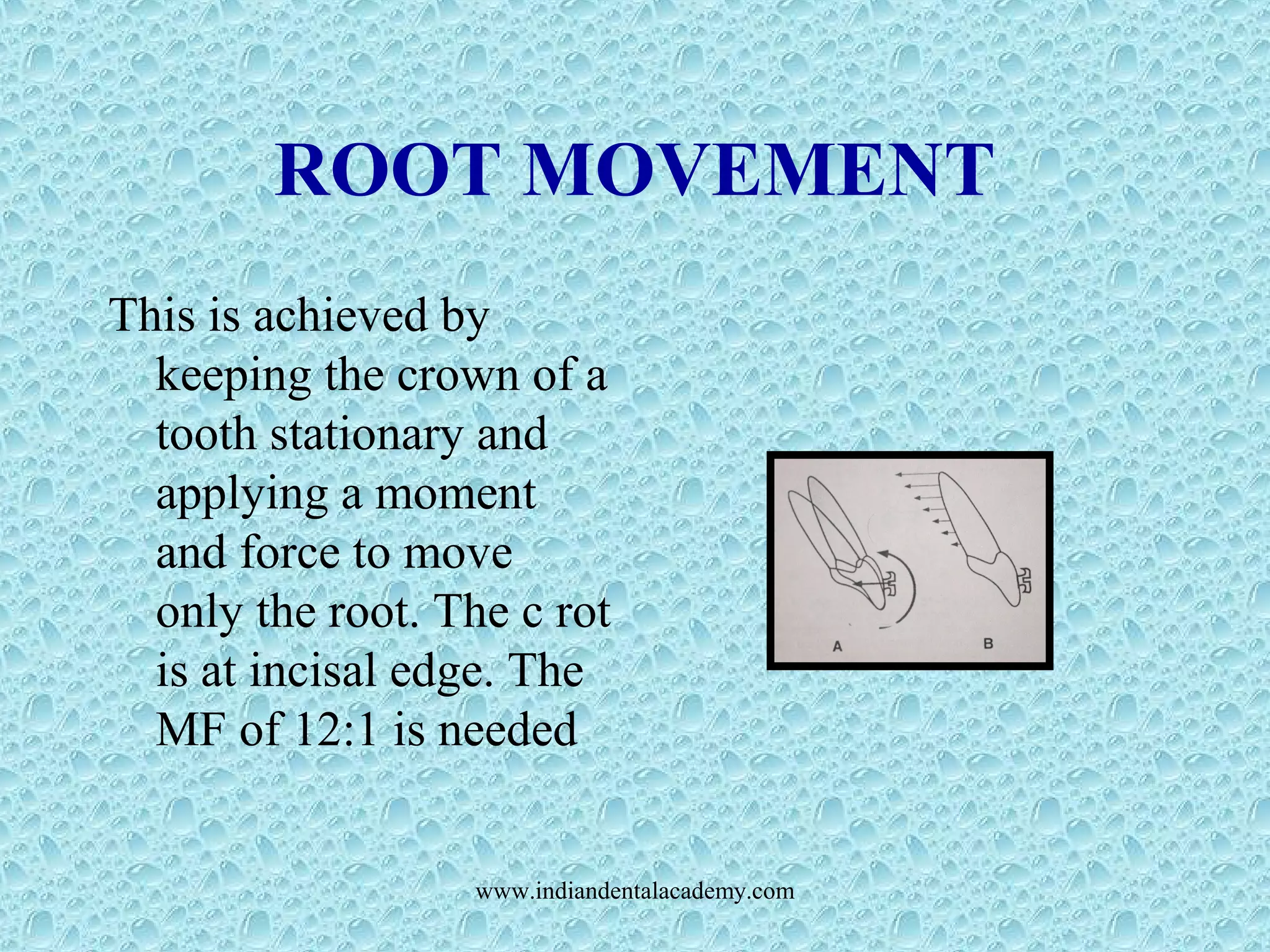ROOT MOVEMENT
This is achieved by
keeping the crown of a
tooth stationary and
applying a moment
and force to move
only the root. The c rot
is at incisal edge. The
MF of 12:1 is needed
www.indiandentalacademy.com
 