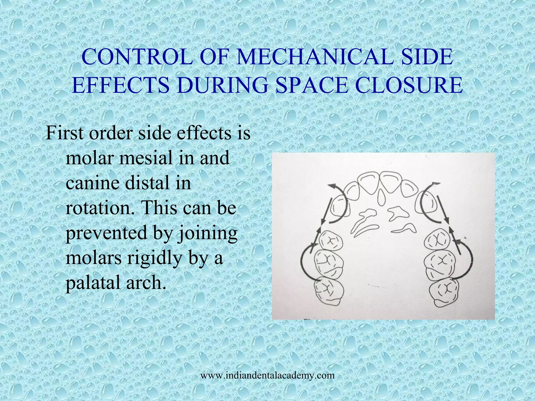 CONTROL OF MECHANICAL SIDE
EFFECTS DURING SPACE CLOSURE
First order side effects is
molar mesial in and
canine distal in
rotation. This can be
prevented by joining
molars rigidly by a
palatal arch.
www.indiandentalacademy.com
 