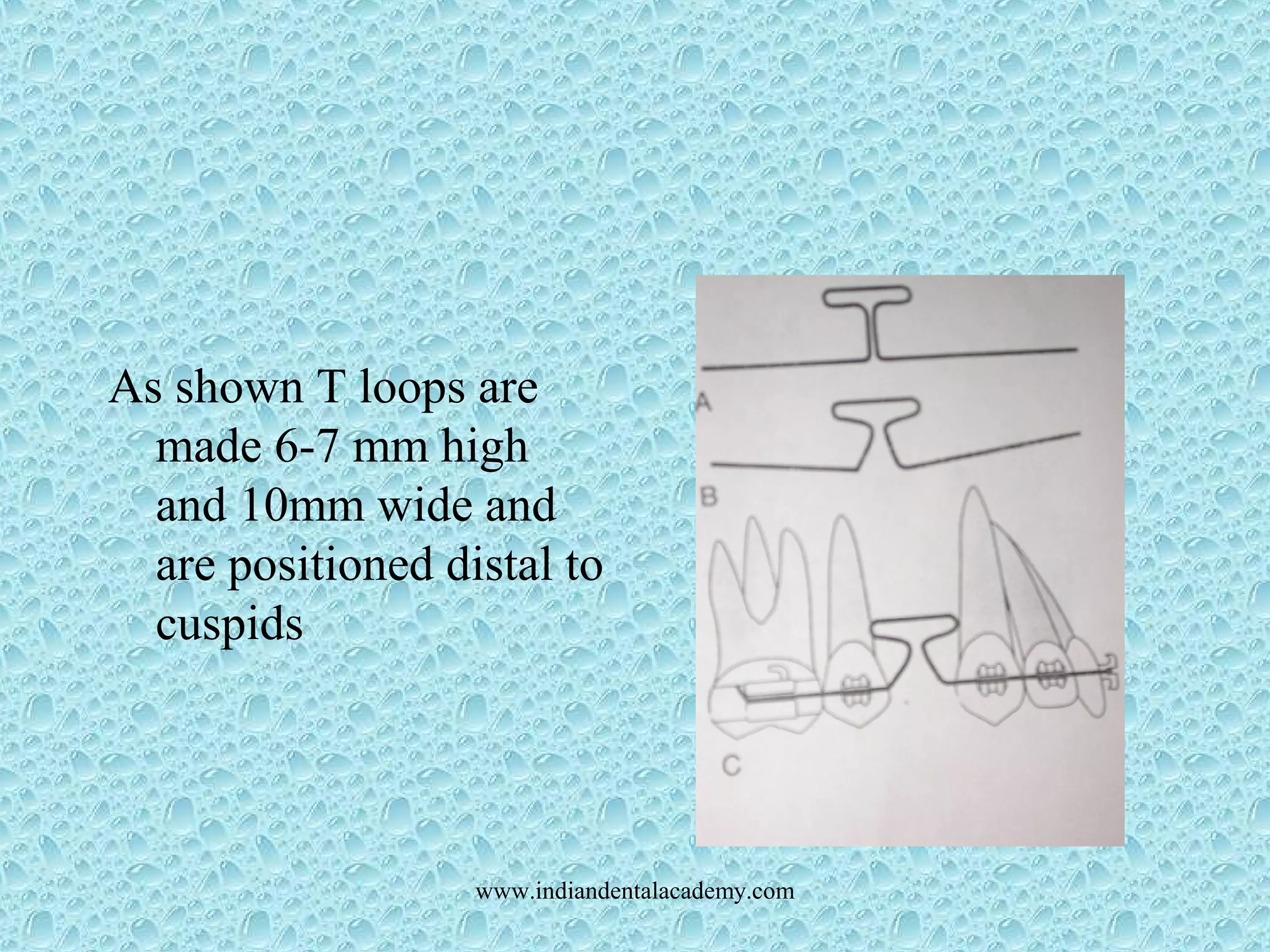 As shown T loops are
made 6-7 mm high
and 10mm wide and
are positioned distal to
cuspids
www.indiandentalacademy.com
 