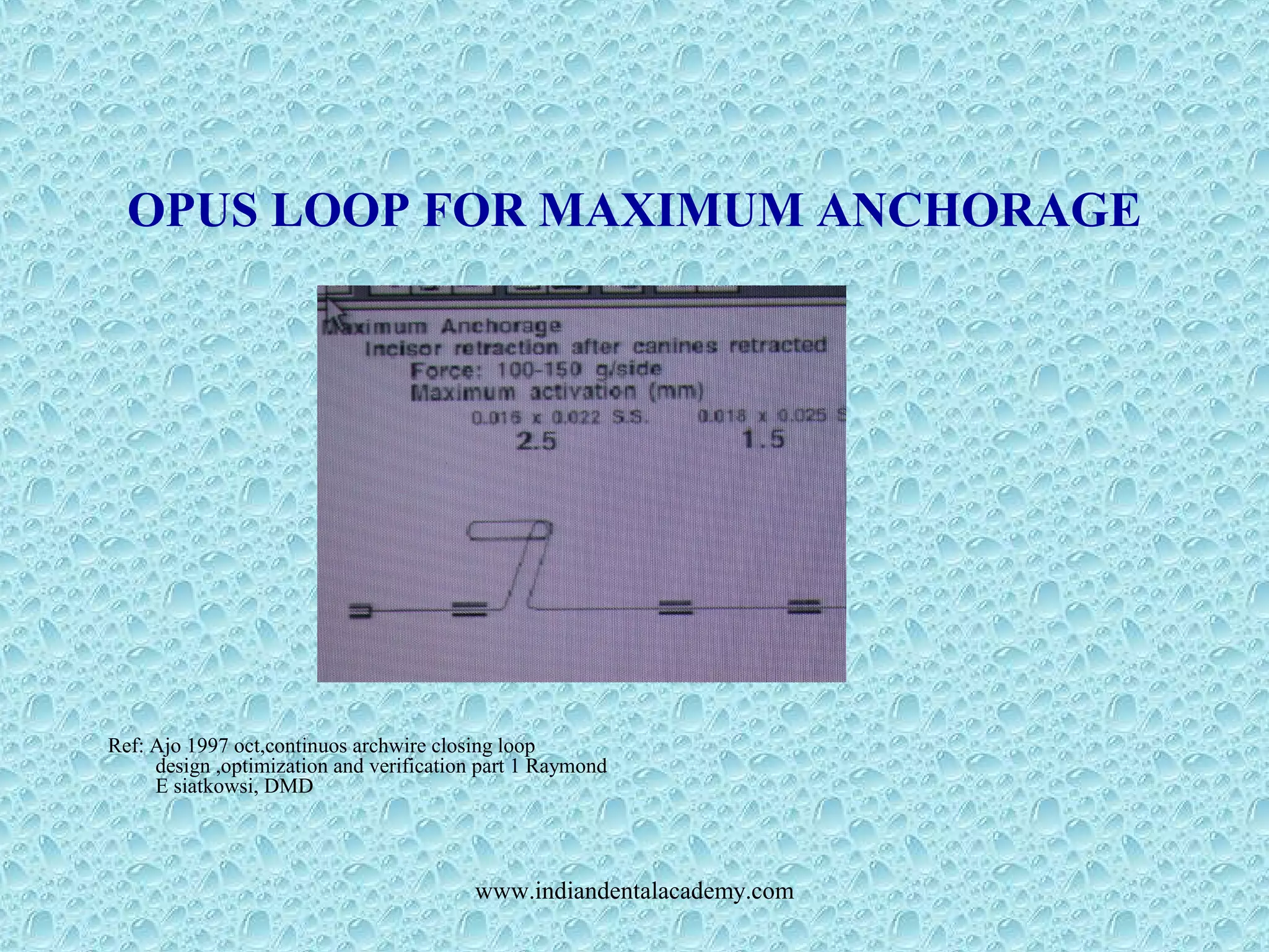 OPUS LOOP FOR MAXIMUM ANCHORAGE
Ref: Ajo 1997 oct,continuos archwire closing loop
design ,optimization and verification part 1 Raymond
E siatkowsi, DMD
www.indiandentalacademy.com
 